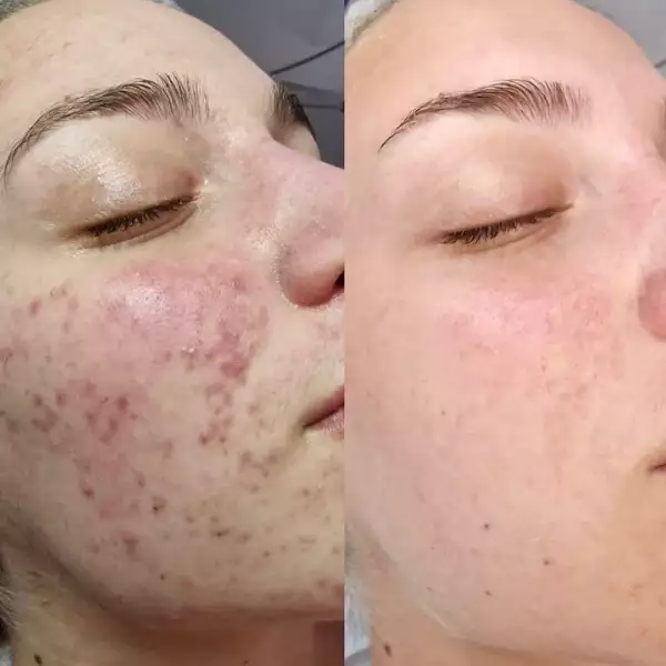 Antes e depois — Camila, 21 anos