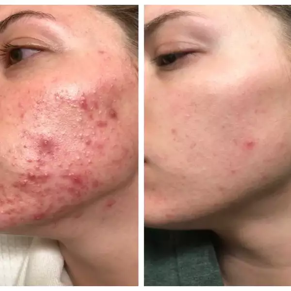 Antes e depois — Carla, 30 anos