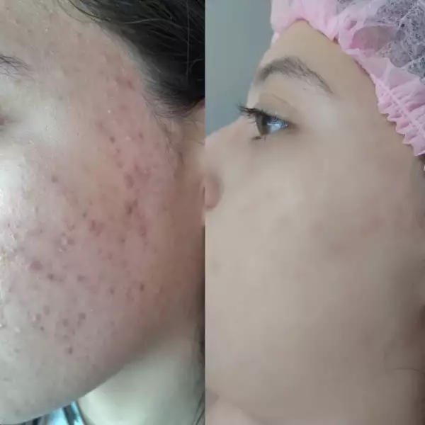 Antes e depois — Maria Eduarda, 15 anos