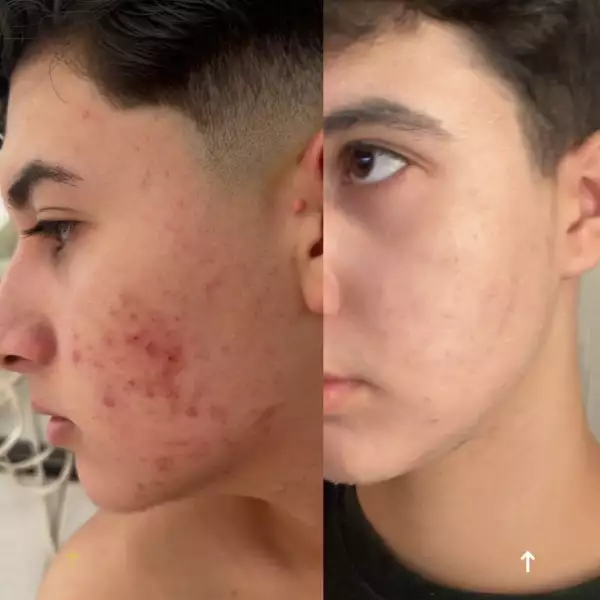Antes e depois — Matheus, 14 anos